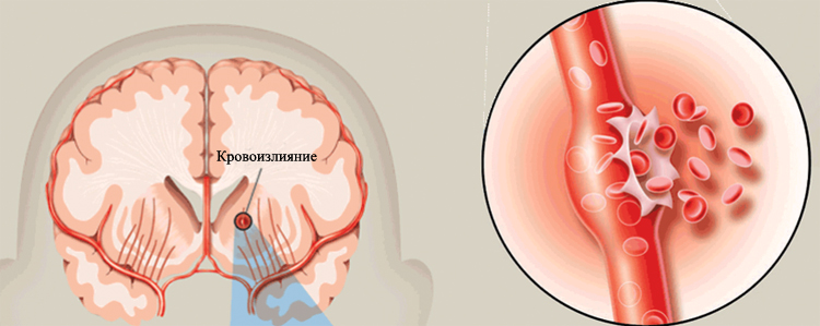 Ишемический инсульт после кровоизлияния в мозг