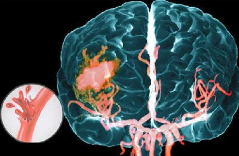 Кровоизлияние мозга после инсульта