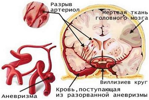 Ишемический инсульт головного мозга с кровоизлиянием в мозг