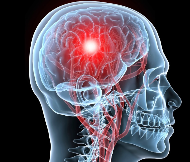 Инсульт или кровоизлияние в головной мозг