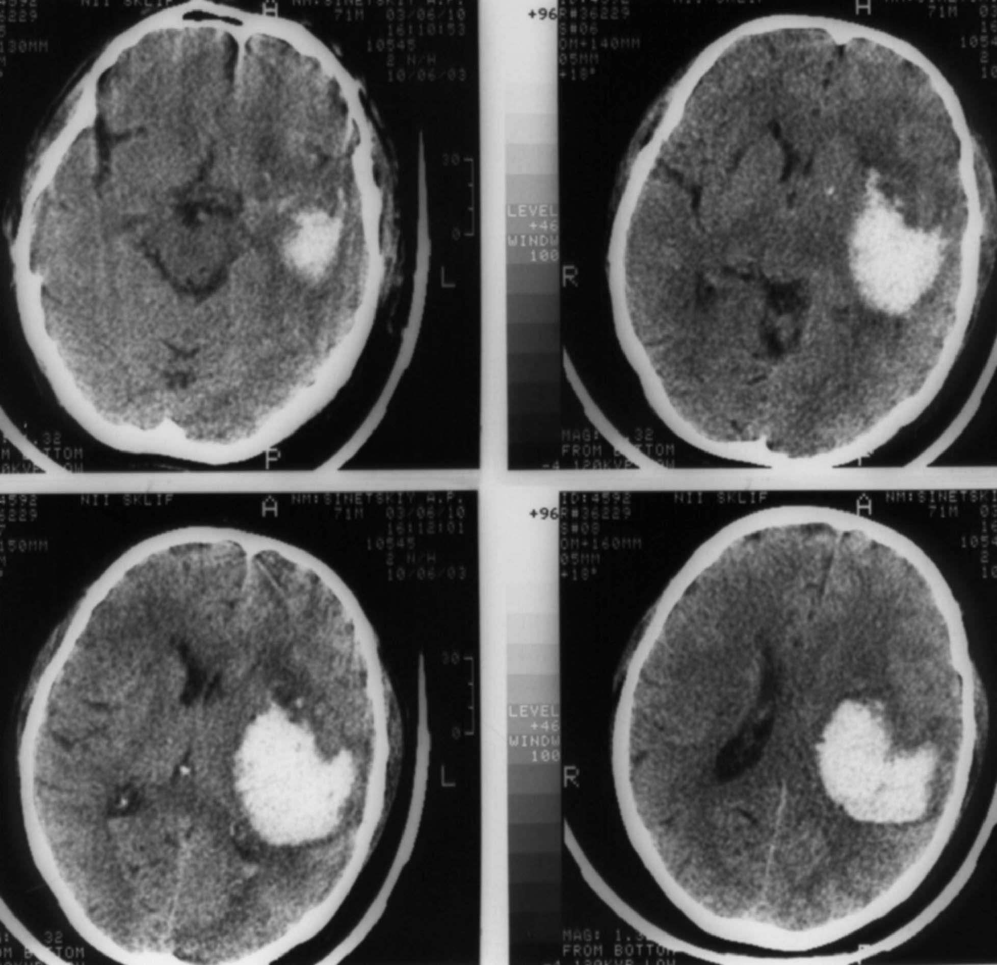 Последствия после кровоизлияния в мозг инсульт